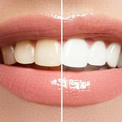 3 Popular Teeth Whitening Procedures