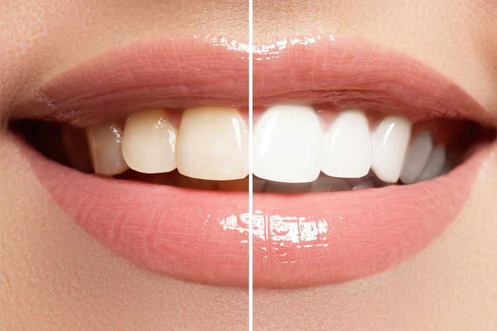 3 Popular Teeth Whitening Procedures