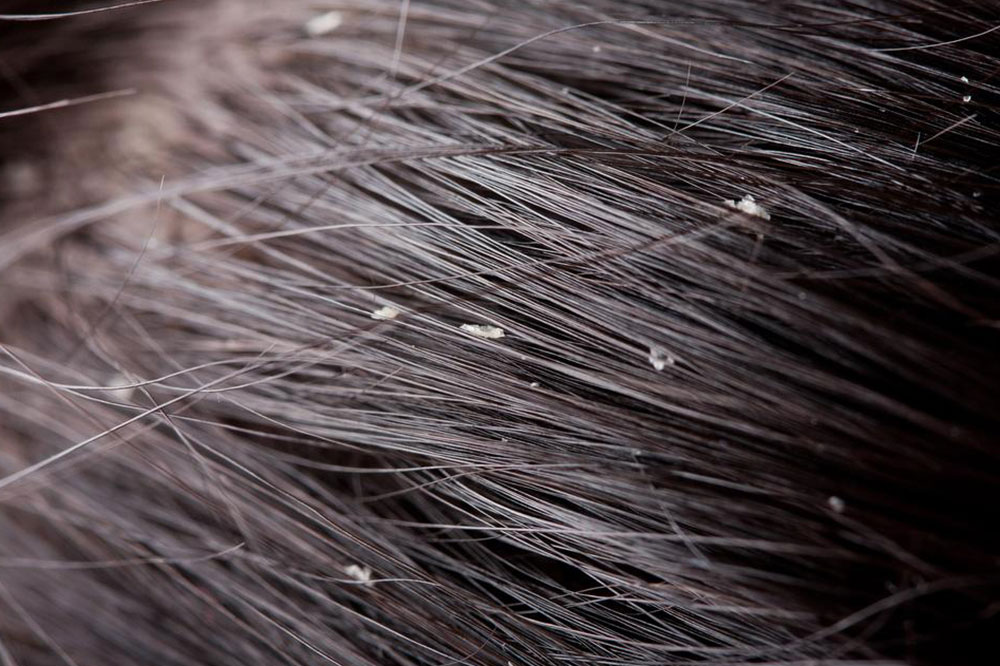 Tips to Prevent Dandruff and Flakes
