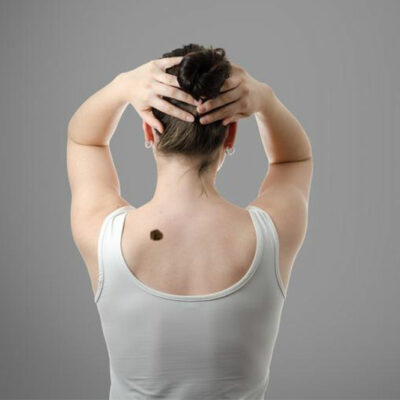 Tips to Prevent Skin Cancer