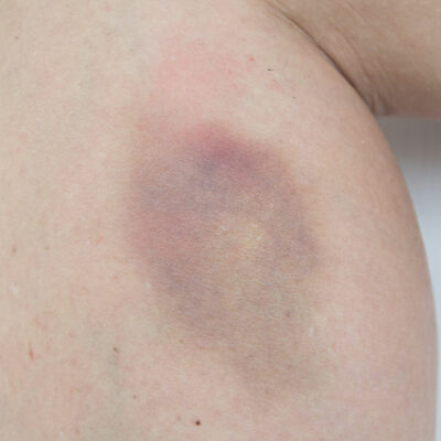 Treatment Methods for Hemophilia