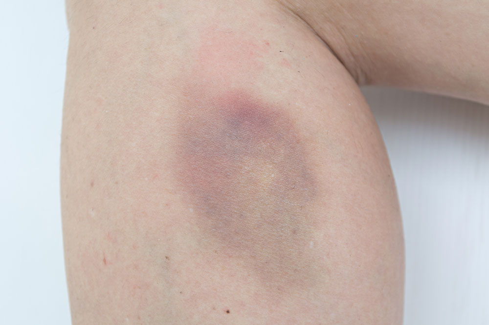 Treatment Methods for Hemophilia