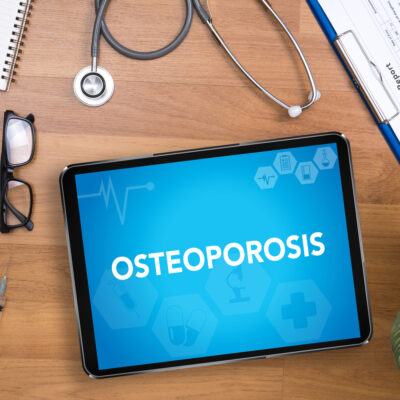 The Top 5 Osteoporosis Treatments