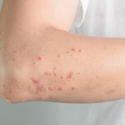 Treatment Options for Atopic Dermatitis