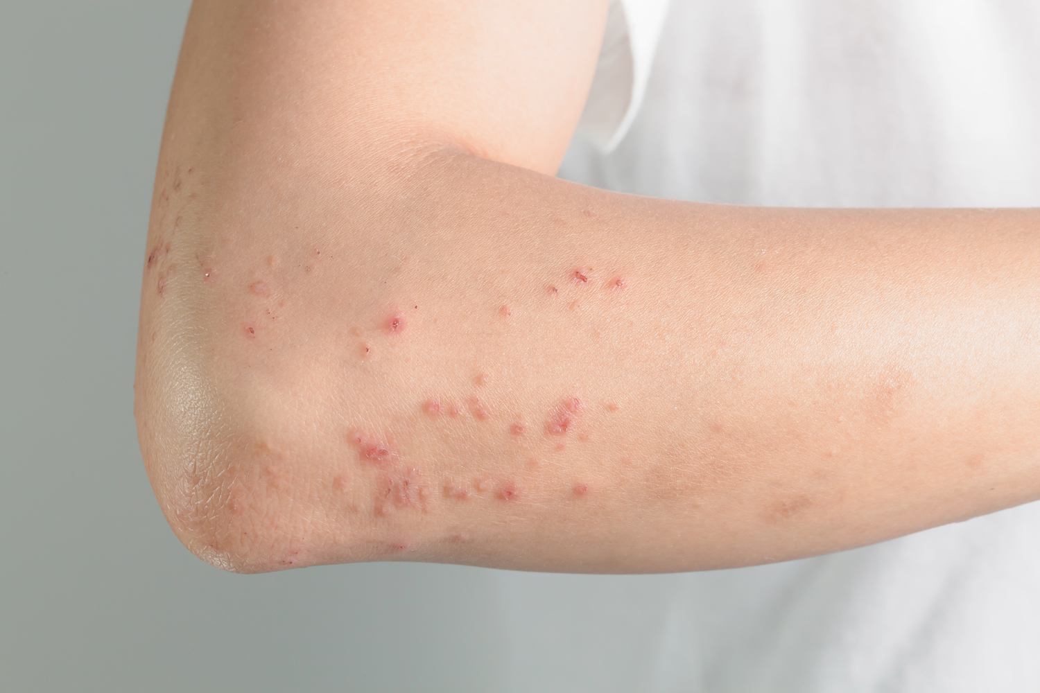 Treatment Options for Atopic Dermatitis